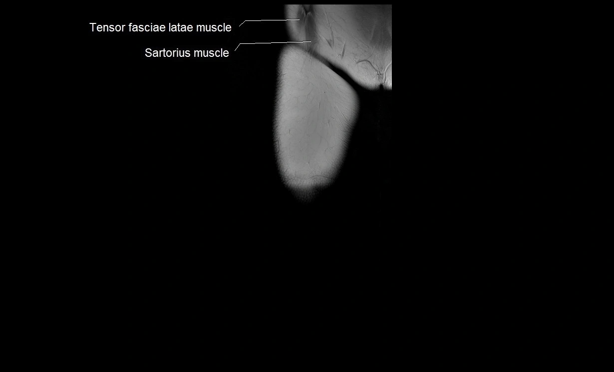 MRI thigh coronal cross sectional anatomy image 1.webp